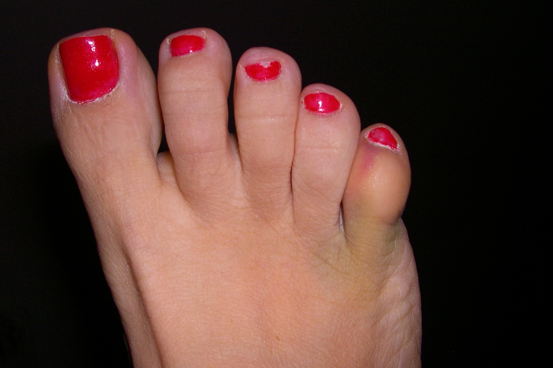 my-split-little-toenails-or-accessory-nail-on-the-5th-toe-remedygrove